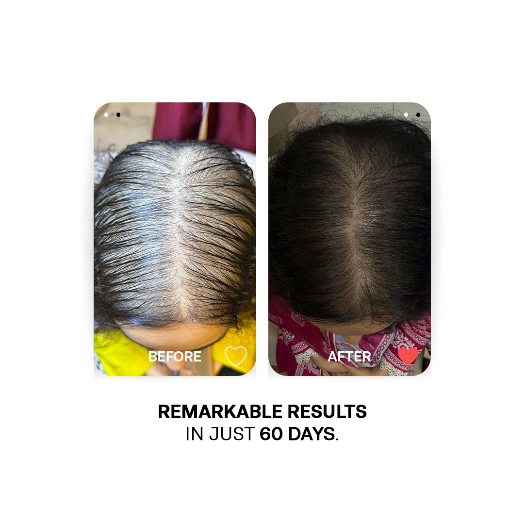 Andro-D - Natural DHT Blocker -- For Hormonal hair Loss