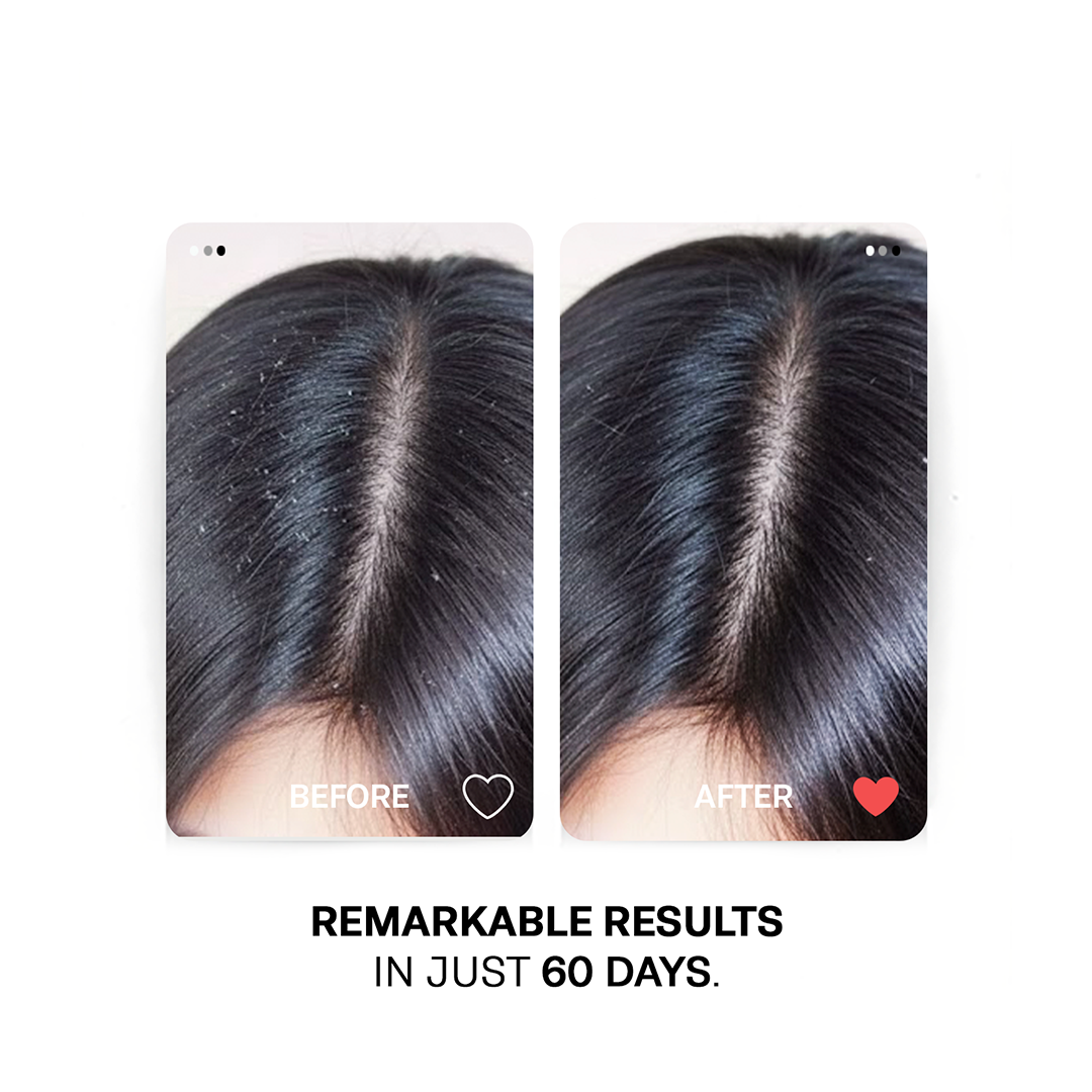 Anti Dandruff Oil - With Tea Tree, Clove, and Thyme Oil