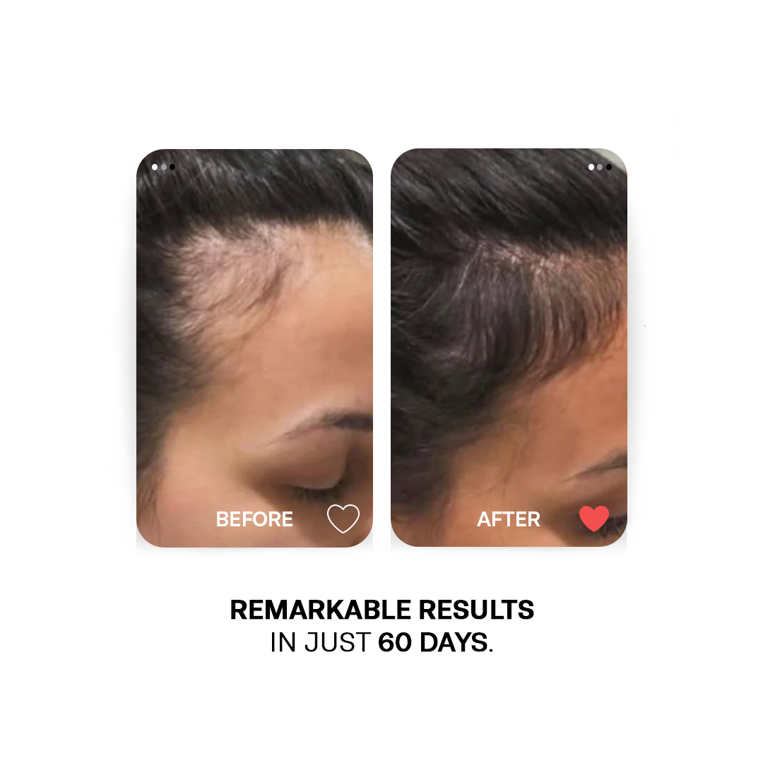 Peppermint Essential Oil - Stimulates scalp circulation  and reduces migraines