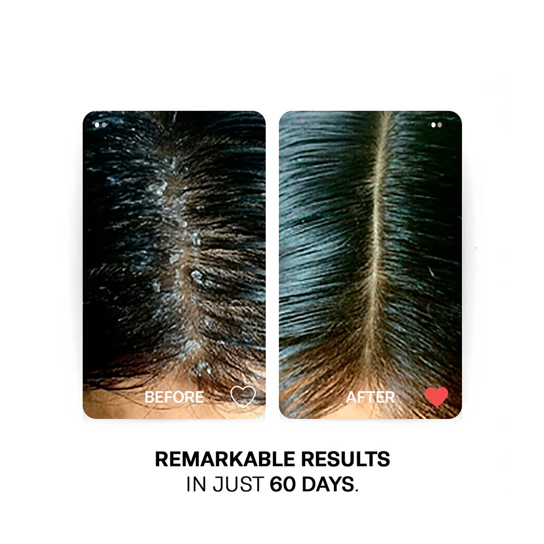 MULTIVITAMINS SCALP SOOTHING GEL - For Fighting Dandruff, Dryness and Itching